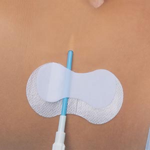 Tidi Grip-lok Picc/cvc Securement Device 3601cvc